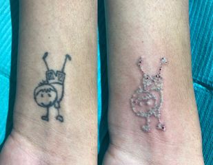 Antes y después de Eliminación de Tatuaje