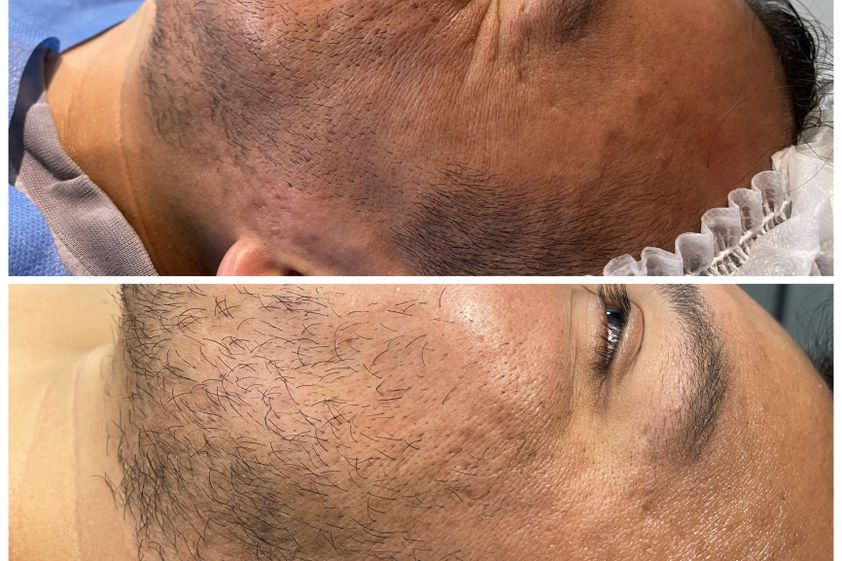Toxina botulínica antes y después - 825946