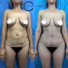 Abdominoplastia 
