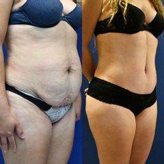 Abdominoplastia - Dr. Carlos González Alvarado