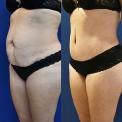 Abdominoplastia - Dr. Carlos González Alvarado