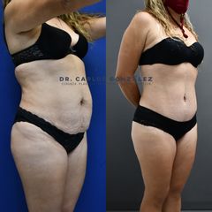 Abdominoplastia - Dr. Carlos González Alvarado
