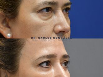 Blefaroplastia - 798864
