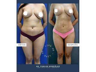 Liposucción - Dr. Carlos González Alvarado