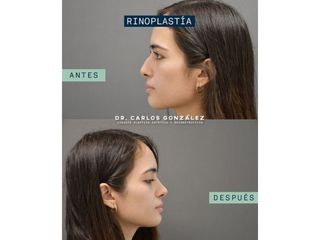Rinoplastia - Dr. Carlos González Alvarado