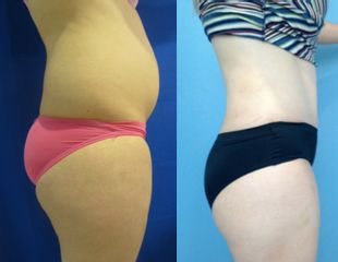 Antes y después de Abdominoplastia