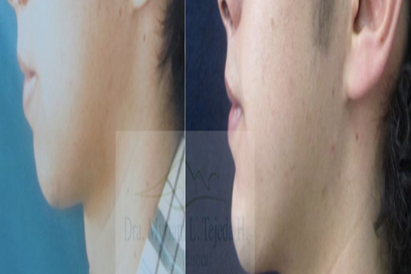 Mentoplastia antes y después - 428510