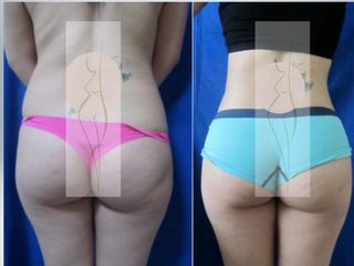 Antes y después de Lipoescultura y aumento de glúteo