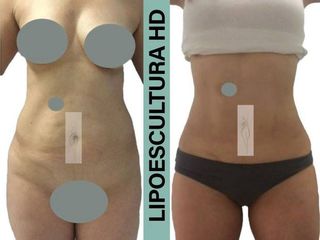 Antes y después de lipoescultura HD