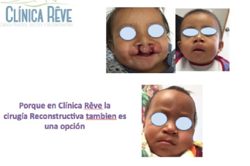 Cirugía plástica reconstructiva antes y después - 607298