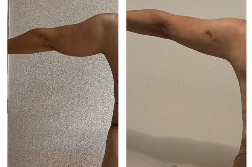 Braquioplastia antes y después - 843368