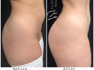 Antes y después de un Contorno Corporal, mediante lipoescultura.