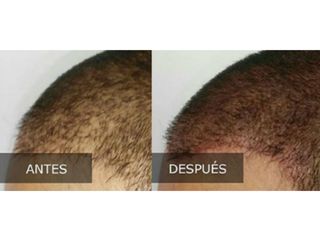 Antes y después de trasplante de cabello 