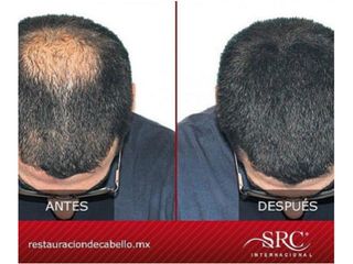 Antes y después de trasplante de cabello 