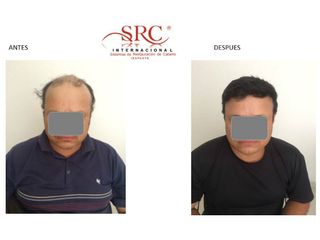 Antes y después de trasplante de cabello 