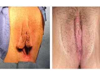 Rejuvenecimiento vaginal