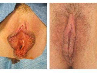 Rejuvenecimiento vaginal