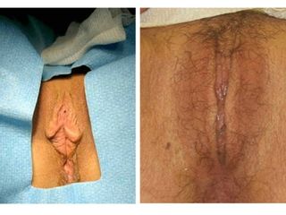 Rejuvenecimiento vaginal