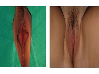 Labioplastia