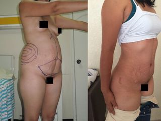 Antes y después de Abdominoplastia