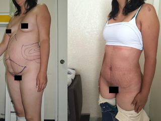 Antes y después de Abdominoplastia