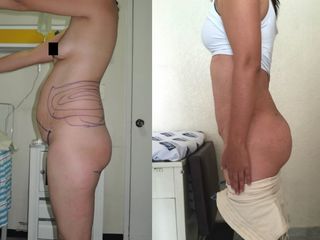 Antes y después de Lipoabdominoplastía antes y después