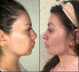 Antes y después de mentoplastía antes y después