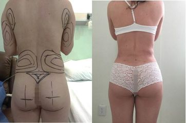 Antes y después de liposucción antes y después