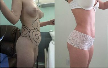 Antes y después de Lipoescultura