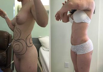 Antes y después de Lipoescultura