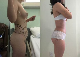 Antes y después de Lipoescultura