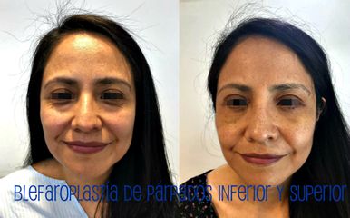Antes y después de Blefaroplastia Dr. Alejandro Cruz Segura