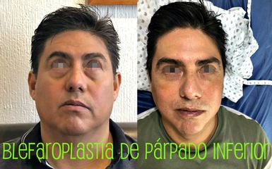 Antes y después de Blefaroplastia 