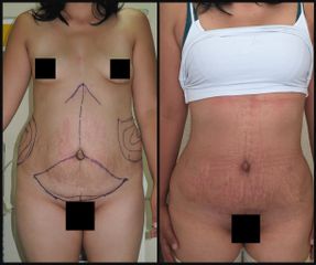 Antes y después de Liposucción