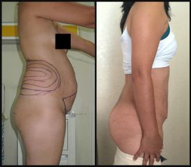 Antes y después de Liposucción
