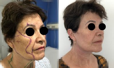 Antes y después de Rejuvenecimiento facial 
