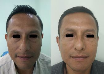 Antes y después de Blefaroplastia hombre 