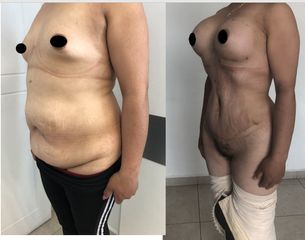 Antes y después de Mommy makeover