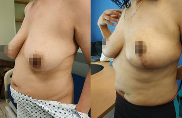 Antes y después de Reducción de mamas 