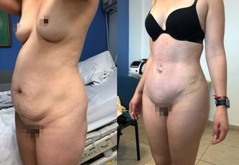Antes y después de Abdominoplastia