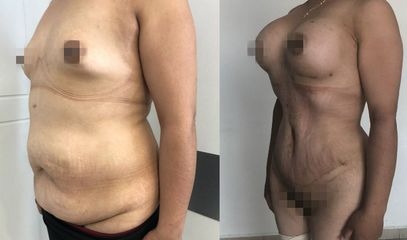 Antes y después de Mommy makeover 