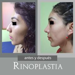 Rinoplastia - Dr. Alejandro Cruz Segura