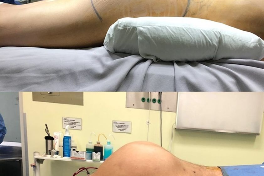Gluteoplastia antes y después - 775689