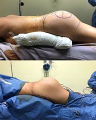 Antes y después de Aumento glúteos