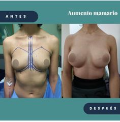 Antes y después de Aumento de busto