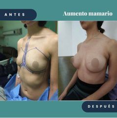 Antes y después de Aumento de busto 