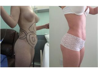 Antes y después de Lipoescultura