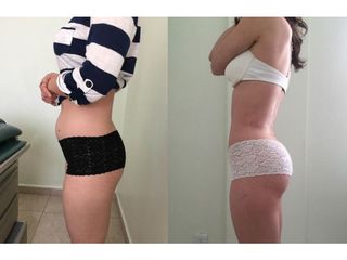Antes y después de Lipoescultura