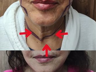 Lifting antes y después - 878419