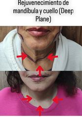 Lifting mandibula y cuello - Dr. Alejandro Cruz Segura